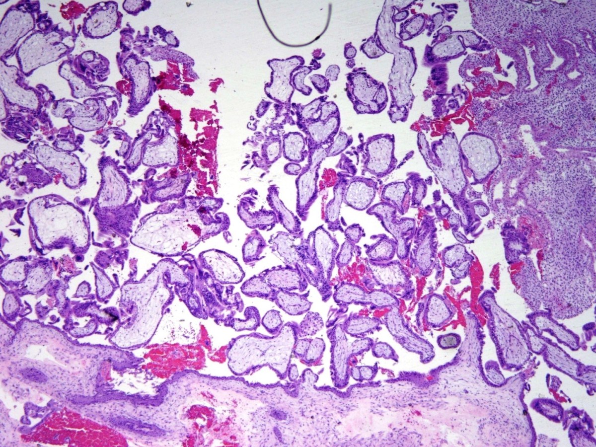 Products of Conception