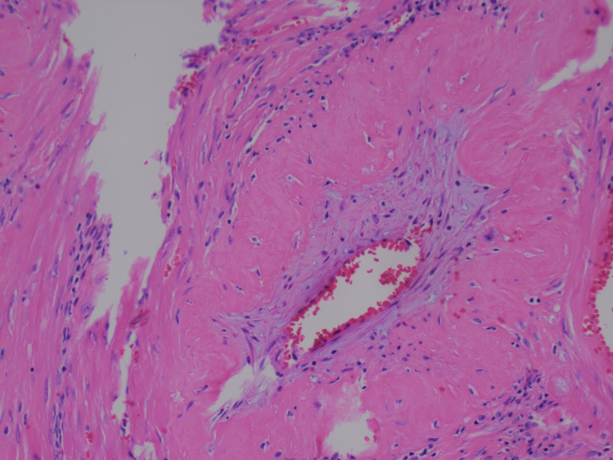 Delayed Postpartum Haemorrhage