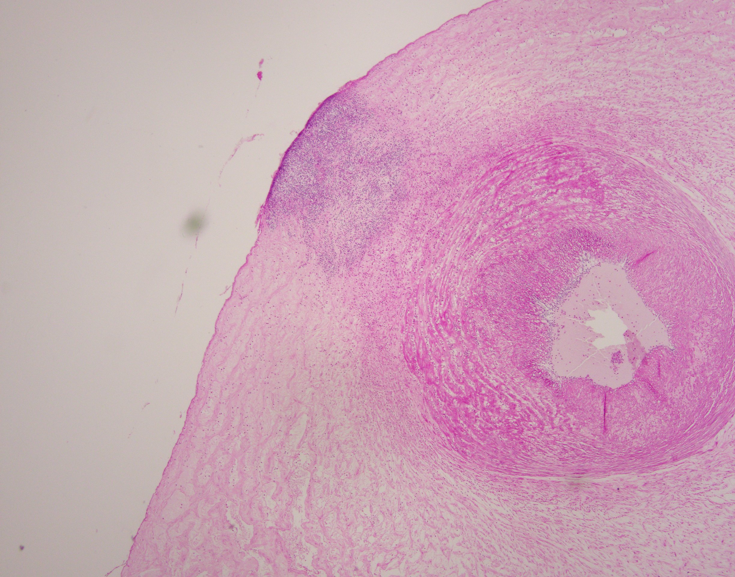 Funisitis Umbilical Cord – ThinkPlacenta