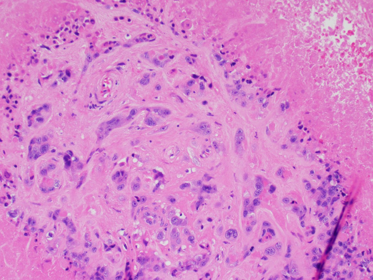 Epithelioid Trophoblastic Tumor and Differential&nbsp;Diagnoses